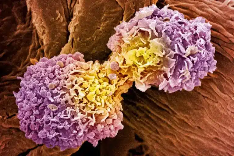 How Breast Cancer Spreads and Recurs