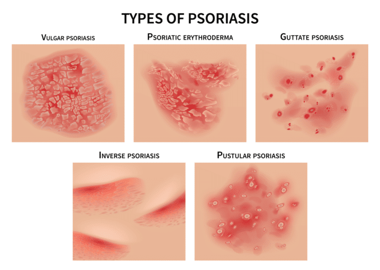 8 of the most common places for psoriasis plaques