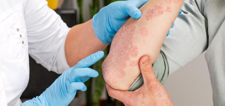 Managing chronic inflammation with psoriasis