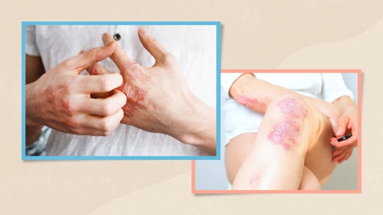 A visual guide to what is happening in the body during a psoriasis flare