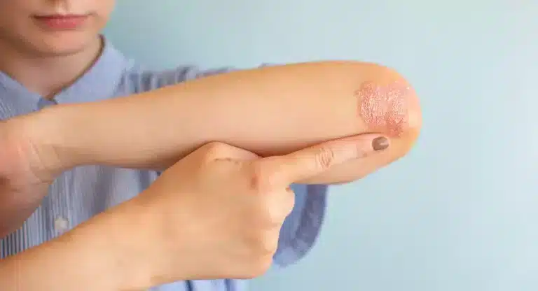 A brief history of psoriasis and what we know now