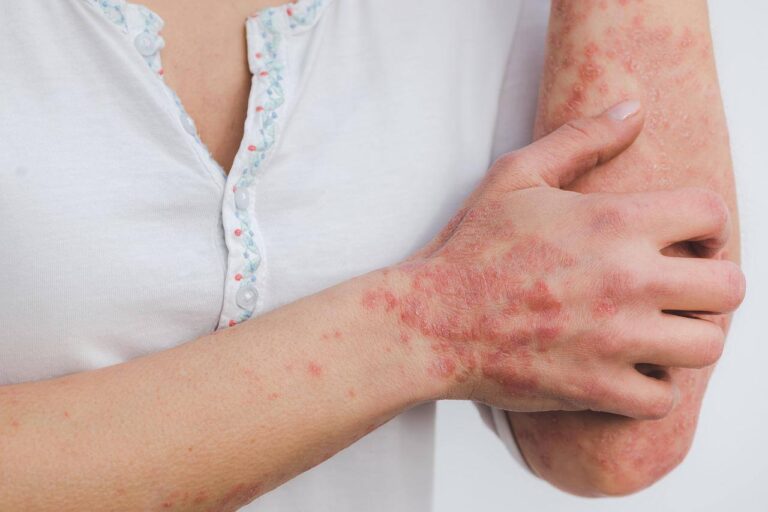 Possible complications of psoriasis