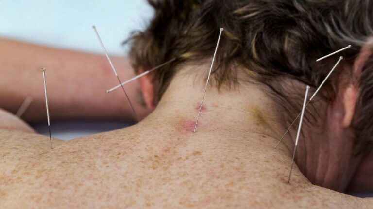 Many practitioners say that acupuncture can help relieve the symptoms of psoriasis and psoriatic arthritis. What does the research say?