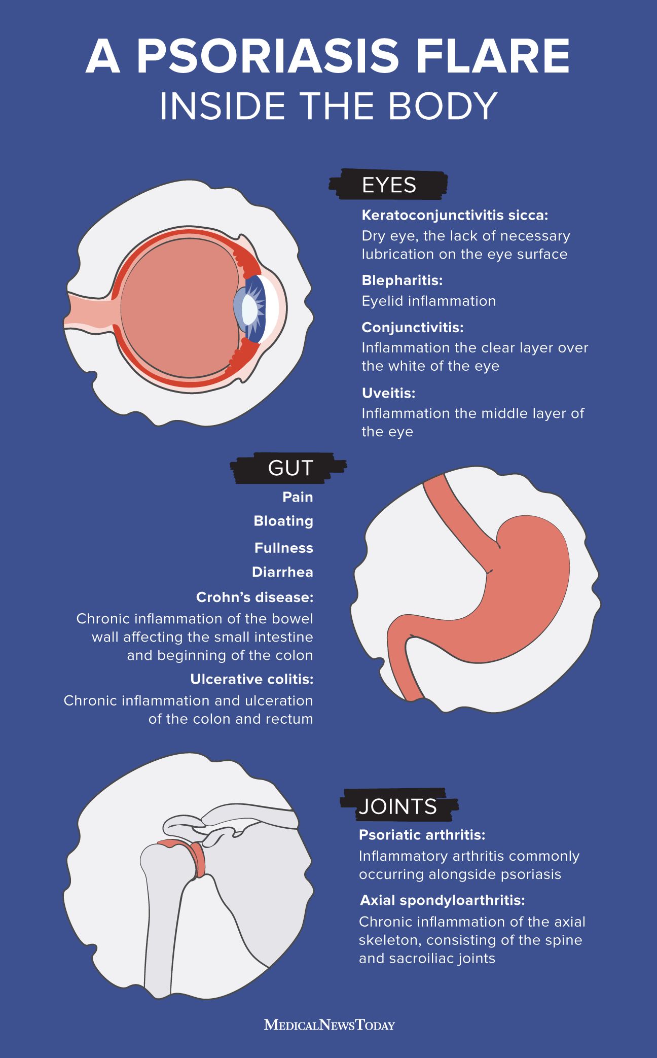 Psoriatic arthritis